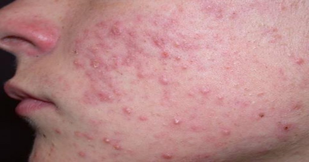 Deficiency of 'these' 4 vitamins causes acne on the face; Know the detailed information