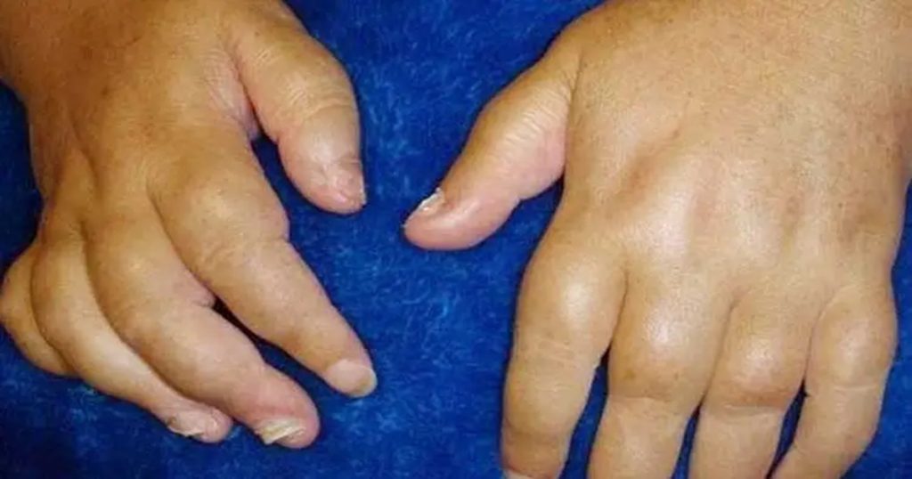 Swollen hands? Then 'these' remedies will provide relief