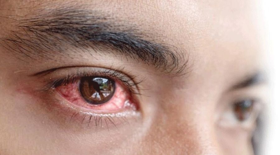 Beware! Be aware that eye infection is spreading rapidly in the state